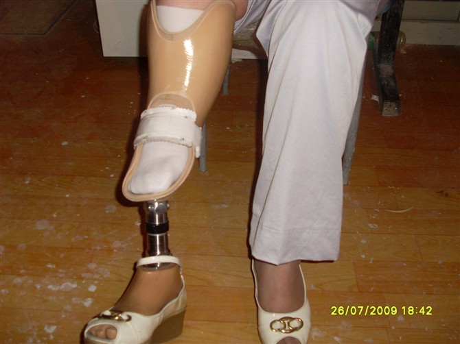 畸形腿、長短腿-2(圖1)